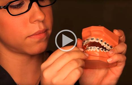 Video thumbnail of a woman demonstrating how to floss while wearing braces on a realistic mold of a mouth with braces