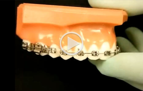 Video thumbnail showing a rubber glove-covered hand holding a realist mold of top teeth and metal braces